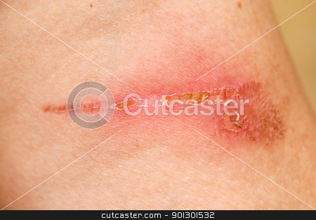 To use this stock image in your creative project, please select the size you need over to the right and click the "Add to Cart" button.
Your downloaded image will come with the Cutcaster watermark removed so don’t worry about the watermark you see on this page. Burn Scar Detail stock photo, A burn scar that is partly healed by Tyler Olson