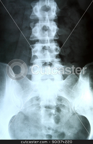 X-ray of the pelvis and spinal column. X-ray of the pelvis and spinal column. stock photo, X-ray of the pelvis and spinal column. by Keng po Leung