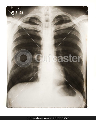 To use this stock image in your creative project, please select the size you need over to the right and click the "Add to Cart" button.
Your downloaded image will come with the Cutcaster watermark removed so don’t worry about the watermark you see on this page. Chest X Ray stock photo, Chest X Ray by Haider Azim