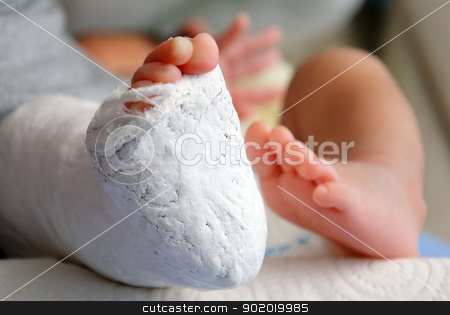 Baby foot in bandage and cast Baby foot in bandage and cast stock photo, Close up of baby foot in bandage and cast by bigjom