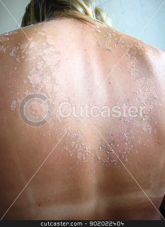Burn from the sun on the body Burn from the sun on the body stock photo, Burn from the sun on a back of the girl by Alexander Matvienko
