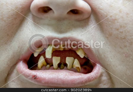 Tooth Decay Tooth Decay stock photo, Woman with severe dental oral tooth decay by Robert Byron