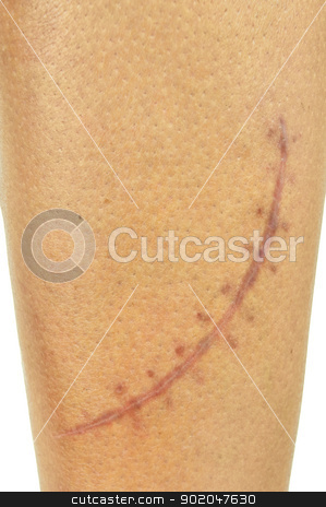 To use this stock image in your creative project, please select the size you need over to the right and click the "Add to Cart" button.
Your downloaded image will come with the Cutcaster watermark removed so don’t worry about the watermark you see on this page. Close-up of a big, fresh scar stock photo, Close-up of a big, fresh scar on a male leg. Two months after injury, 15 cm long, 10 stitches. by Kaja Twardy