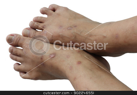 To use this stock image in your creative project, please select the size you need over to the right and click the "Add to Cart" button.
Your downloaded image will come with the Cutcaster watermark removed so don’t worry about the watermark you see on this page. Psoriasis is a chronic stock photo, non-contagious disease that affects mainly the skin by Suphatthra China