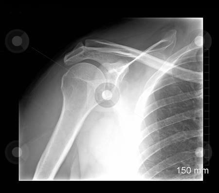 Shoulder xray 2 Shoulder xray 2 stock photo, Shoulder xray isolated on black background by Stacy Barnett