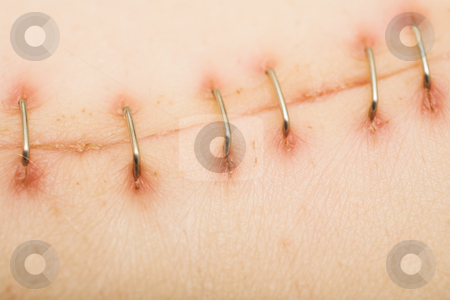 To use this stock image in your creative project, please select the size you need over to the right and click the "Add to Cart" button.
Your downloaded image will come with the Cutcaster watermark removed so don’t worry about the watermark you see on this page. Scar #1 stock photo, Metal staples (satures) in a scar left from a Laparotomy/laparoscopy by Sean Nel