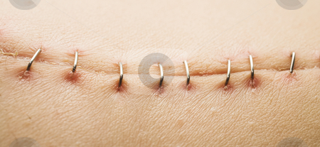 Scar #3 Scar #3 stock photo, Metal staples (satures) in a scar left from a Laparotomy/laparoscopy by Sean Nel