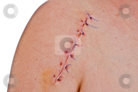 To use this stock image in your creative project, please select the size you need over to the right and click the "Add to Cart" button.
Your downloaded image will come with the Cutcaster watermark removed so don’t worry about the watermark you see on this page. Scar stock photo, Close-up picture of a scar on a female shoulder with stitch by Birgit Reitz-Hofmann