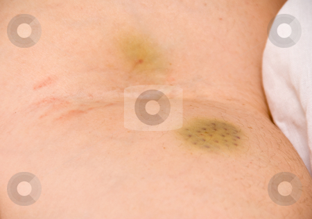 To use this stock image in your creative project, please select the size you need over to the right and click the "Add to Cart" button.
Your downloaded image will come with the Cutcaster watermark removed so don’t worry about the watermark you see on this page. IV Bruise stock photo, A bruise caused by the insertion of an IV needle by Robert Byron