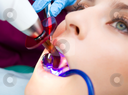 Dentist technology Dentist technology stock photo, Close-up of female with open mouth, having teeth done with ultraviloet lamp by dentist by vilevi