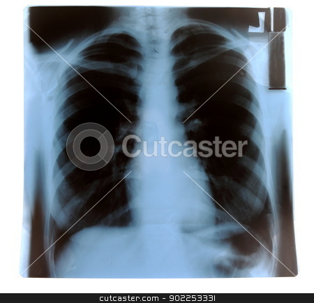 To use this stock image in your creative project, please select the size you need over to the right and click the "Add to Cart" button.
Your downloaded image will come with the Cutcaster watermark removed so don’t worry about the watermark you see on this page. X-Ray stock photo, X-Ray of healthy, non-smoker person's lungs. by MarcinSl1987