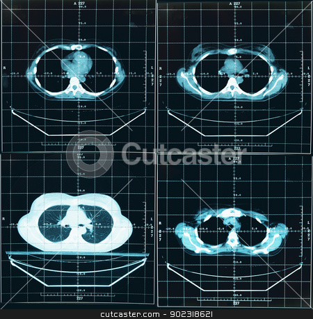 To use this stock image in your creative project, please select the size you need over to the right and click the "Add to Cart" button.
Your downloaded image will come with the Cutcaster watermark removed so don’t worry about the watermark you see on this page. Tomography of human thorax stock photo, Four images - tomography of human thorax by Alexey Romanov