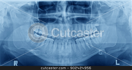 To use this stock image in your creative project, please select the size you need over to the right and click the "Add to Cart" button.
Your downloaded image will come with the Cutcaster watermark removed so don’t worry about the watermark you see on this page. Panoramic x-ray image of teeth stock photo, Panoramic x-ray image of teeth. Problem with wisdom tooth. by Kaja Twardy