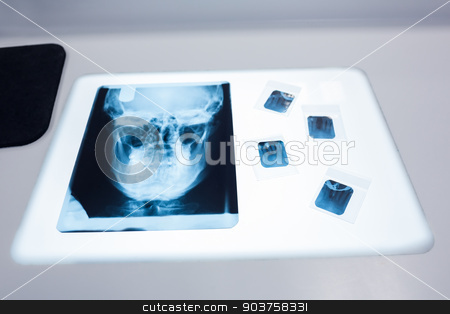 To use this stock image in your creative project, please select the size you need over to the right and click the "Add to Cart" button.
Your downloaded image will come with the Cutcaster watermark removed so don’t worry about the watermark you see on this page. Close up of a x-ray of a human skull on the table stock photo, Close up of a x-ray of a human skull on the table at the dental clinic by Wavebreak Media