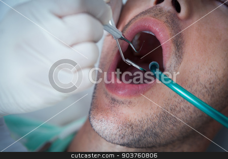 To use this stock image in your creative project, please select the size you need over to the right and click the "Add to Cart" button.
Your downloaded image will come with the Cutcaster watermark removed so don’t worry about the watermark you see on this page. Close up of man having his teeth examined stock photo, Close up of man having his teeth examined by dentist by Wavebreak Media