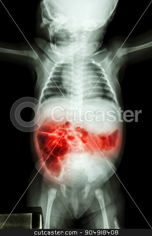 To use this stock image in your creative project, please select the size you need over to the right and click the "Add to Cart" button.
Your downloaded image will come with the Cutcaster watermark removed so don’t worry about the watermark you see on this page. Enteritis (X-ray of sick infant and inflammation of intestine) stock photo, Enteritis (X-ray of sick infant and inflammation of intestine) by stockdevil