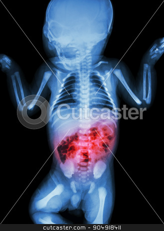 To use this stock image in your creative project, please select the size you need over to the right and click the "Add to Cart" button.
Your downloaded image will come with the Cutcaster watermark removed so don’t worry about the watermark you see on this page. Enteritis (X-ray of sick infant and inflammation of intestine) stock photo, Enteritis (X-ray of sick infant and inflammation of intestine) by stockdevil