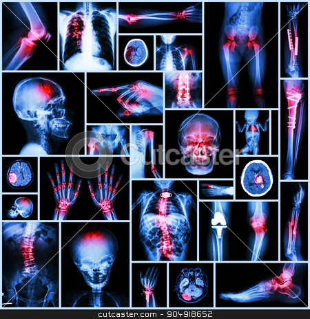 To use this stock image in your creative project, please select the size you need over to the right and click the "Add to Cart" button.
Your downloaded image will come with the Cutcaster watermark removed so don’t worry about the watermark you see on this page. Collection X-ray part of human,Orthopedic operation,Multiple disease (Fracture,Gout,Rheumatoid arthritis,Osteoarthritis knee,Stroke,Brain tumor,Scoliosis,Tuberculosis, etc.) stock photo, Collection X-ray part of human,Orthopedic operation,Multiple disease (Fracture,Gout,Rheumatoid arthritis,Osteoarthritis knee,Stroke,Brain tumor,Scoliosis,Tuberculosis, etc.) by stockdevil