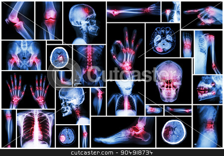 To use this stock image in your creative project, please select the size you need over to the right and click the "Add to Cart" button.
Your downloaded image will come with the Cutcaster watermark removed so don’t worry about the watermark you see on this page. X-ray multiple part of human with multiple disease (stroke, arthritis, gout, rheumatoid, brain tumor, osteoarthritis, etc) stock photo, X-ray multiple part of human with multiple disease (stroke, arthritis, gout, rheumatoid, brain tumor, osteoarthritis, etc) by stockdevil