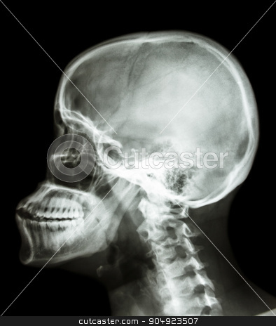To use this stock image in your creative project, please select the size you need over to the right and click the "Add to Cart" button.
Your downloaded image will come with the Cutcaster watermark removed so don’t worry about the watermark you see on this page. human's skull and cervical spine stock photo, film x-ray skull lateral : show human's skull and cervical spine by stockdevil