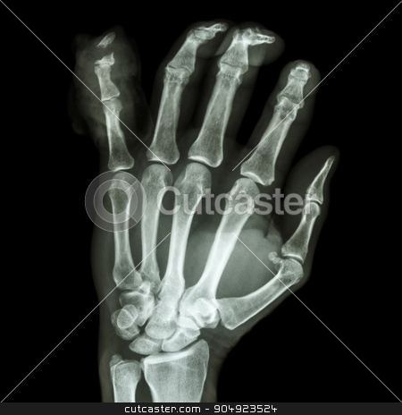 To use this stock image in your creative project, please select the size you need over to the right and click the "Add to Cart" button.
Your downloaded image will come with the Cutcaster watermark removed so don’t worry about the watermark you see on this page. fracture distal pharange little finger stock photo, film x-ray hand AP : show fracture distal pharange little finger by stockdevil