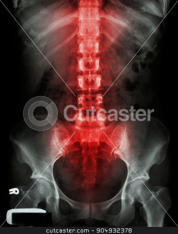 To use this stock image in your creative project, please select the size you need over to the right and click the "Add to Cart" button.
Your downloaded image will come with the Cutcaster watermark removed so don’t worry about the watermark you see on this page. X-ray lumbo-sacral spine and pelvis and inflammation at spine stock photo, X-ray lumbo-sacral spine and pelvis and inflammation at spine by stockdevil