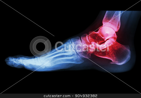 To use this stock image in your creative project, please select the size you need over to the right and click the "Add to Cart" button.
Your downloaded image will come with the Cutcaster watermark removed so don’t worry about the watermark you see on this page. X-ray human's ankle with arthritis stock photo, X-ray human's ankle with arthritis by stockdevil