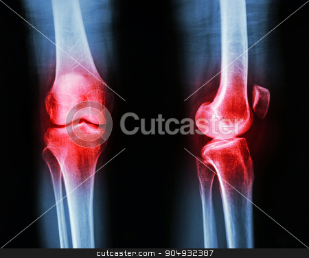 To use this stock image in your creative project, please select the size you need over to the right and click the "Add to Cart" button.
Your downloaded image will come with the Cutcaster watermark removed so don’t worry about the watermark you see on this page. Film x-ray knee AP/lateral : Osteoarthritis knee (Inflammation at knee) stock photo, Film x-ray knee AP/lateral : Osteoarthritis knee (Inflammation at knee) by stockdevil