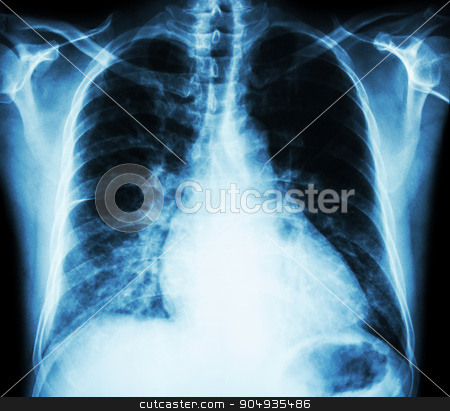 To use this stock image in your creative project, please select the size you need over to the right and click the "Add to Cart" button.
Your downloaded image will come with the Cutcaster watermark removed so don’t worry about the watermark you see on this page. Heart failure ( film x-ray chest PA upright : show cardiomegaly and interstitial infiltrate both lung ) stock photo, Heart failure ( film x-ray chest PA upright : show cardiomegaly and interstitial infiltrate both lung ) by stockdevil