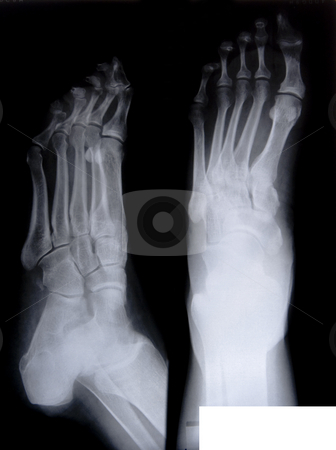 To use this stock image in your creative project, please select the size you need over to the right and click the "Add to Cart" button.
Your downloaded image will come with the Cutcaster watermark removed so don’t worry about the watermark you see on this page. Health medical x ray stock photo, Health medical image of an x ray of the feet by Ivan Montero