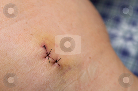 To use this stock image in your creative project, please select the size you need over to the right and click the "Add to Cart" button.
Your downloaded image will come with the Cutcaster watermark removed so don’t worry about the watermark you see on this page. Stitches stock photo, The stitches in the skin of a patient. by Robert Byron