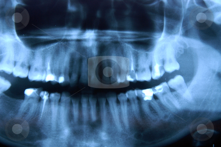 To use this stock image in your creative project, please select the size you need over to the right and click the "Add to Cart" button.
Your downloaded image will come with the Cutcaster watermark removed so don’t worry about the watermark you see on this page. Roentgen - jaw, nandible stock photo, X-ray by Joanna Szycik