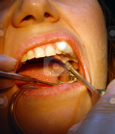 To use this stock image in your creative project, please select the size you need over to the right and click the "Add to Cart" button.
Your downloaded image will come with the Cutcaster watermark removed so don’t worry about the watermark you see on this page. Patient in the dental clinic stock photo, Stomatologist work in clinic, operation - tooth repair by Joanna Szycik