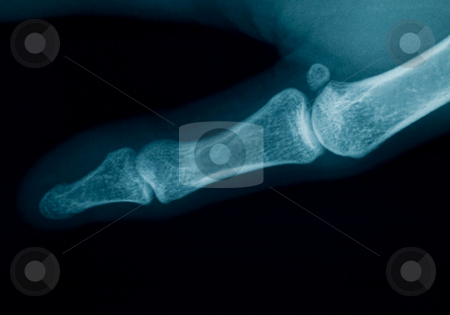 To use this stock image in your creative project, please select the size you need over to the right and click the "Add to Cart" button.
Your downloaded image will come with the Cutcaster watermark removed so don’t worry about the watermark you see on this page. Finger x-ray stock photo, Radiography of a middle aged woman finger by Laurent Dambies