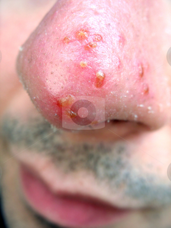 To use this stock image in your creative project, please select the size you need over to the right and click the "Add to Cart" button.
Your downloaded image will come with the Cutcaster watermark removed so don’t worry about the watermark you see on this page. Nose Cold Sore stock photo, A medical condition closeup of the common cold sore virus herpes simplex on an infected victims nose. Triggers can be viral or from strong sun exposure. by Todd Arena