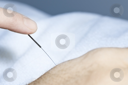 To use this stock image in your creative project, please select the size you need over to the right and click the "Add to Cart" button.
Your downloaded image will come with the Cutcaster watermark removed so don’t worry about the watermark you see on this page. Acupuncture needle in skin stock photo, Manipulation of acupuncture needle inserted in hand by Elena Elisseeva